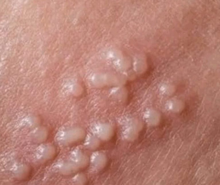 Comment faire partir l’herpès génital rapidement