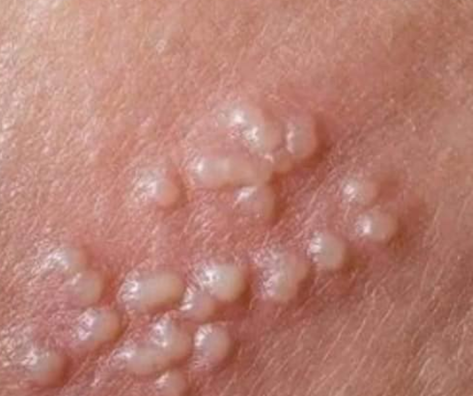 Comment faire partir l’herpès génital rapidement